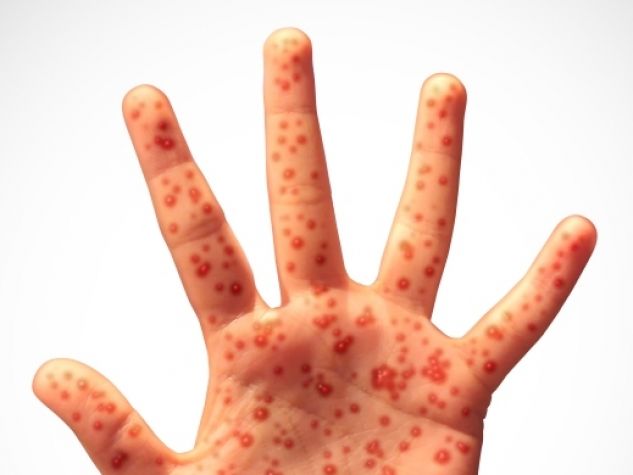 Ragazzi, attenti al morbillo!