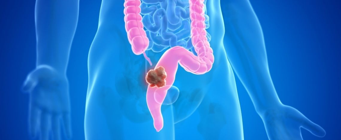 Il tumore al colon retto si può evitare